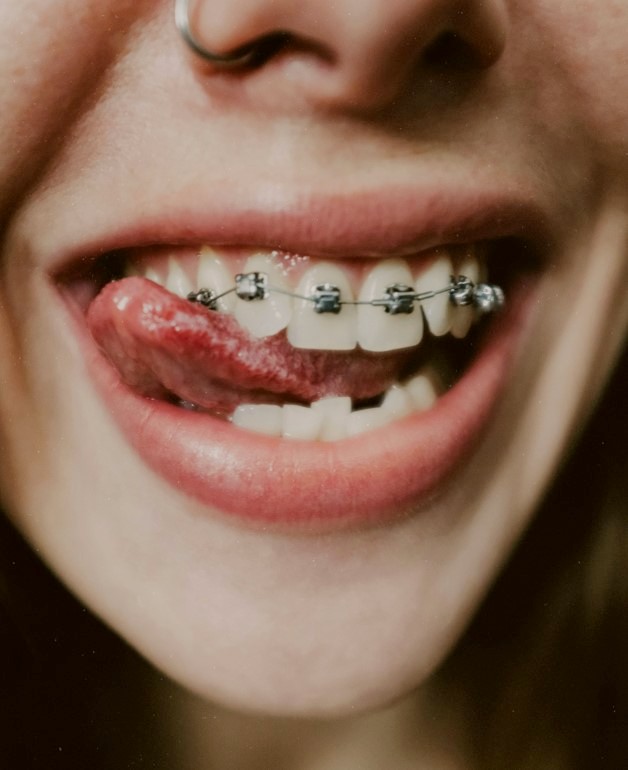 person with orthodontics treatment on their teeth, smile, from longmont braces