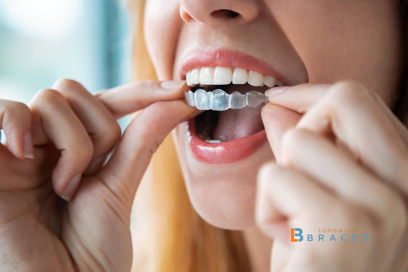 Longmont Braces Highlights Adult Invisalign and Clear Aligners Among Individualized Care Approaches